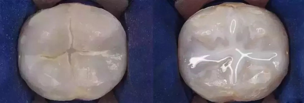 孩子窝沟封闭，爸妈们基本不当回事！—义乌傅氏口腔