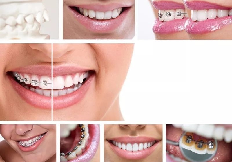牙齿矫正了半年，为何还没变化？—义乌傅氏口腔