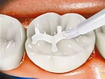 宝宝做窝沟封闭的最佳时机! 宝宝做窝沟封闭的最佳时机!