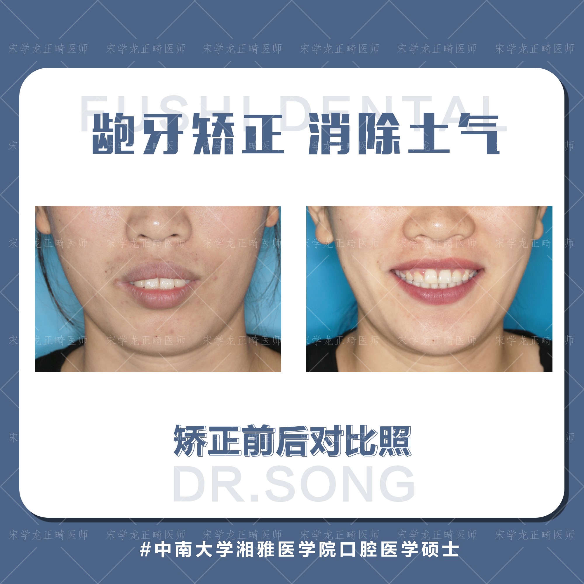 女士凸面型龅牙矫正—义乌傅氏口腔 女士凸面型龅牙矫正—义乌傅氏口腔