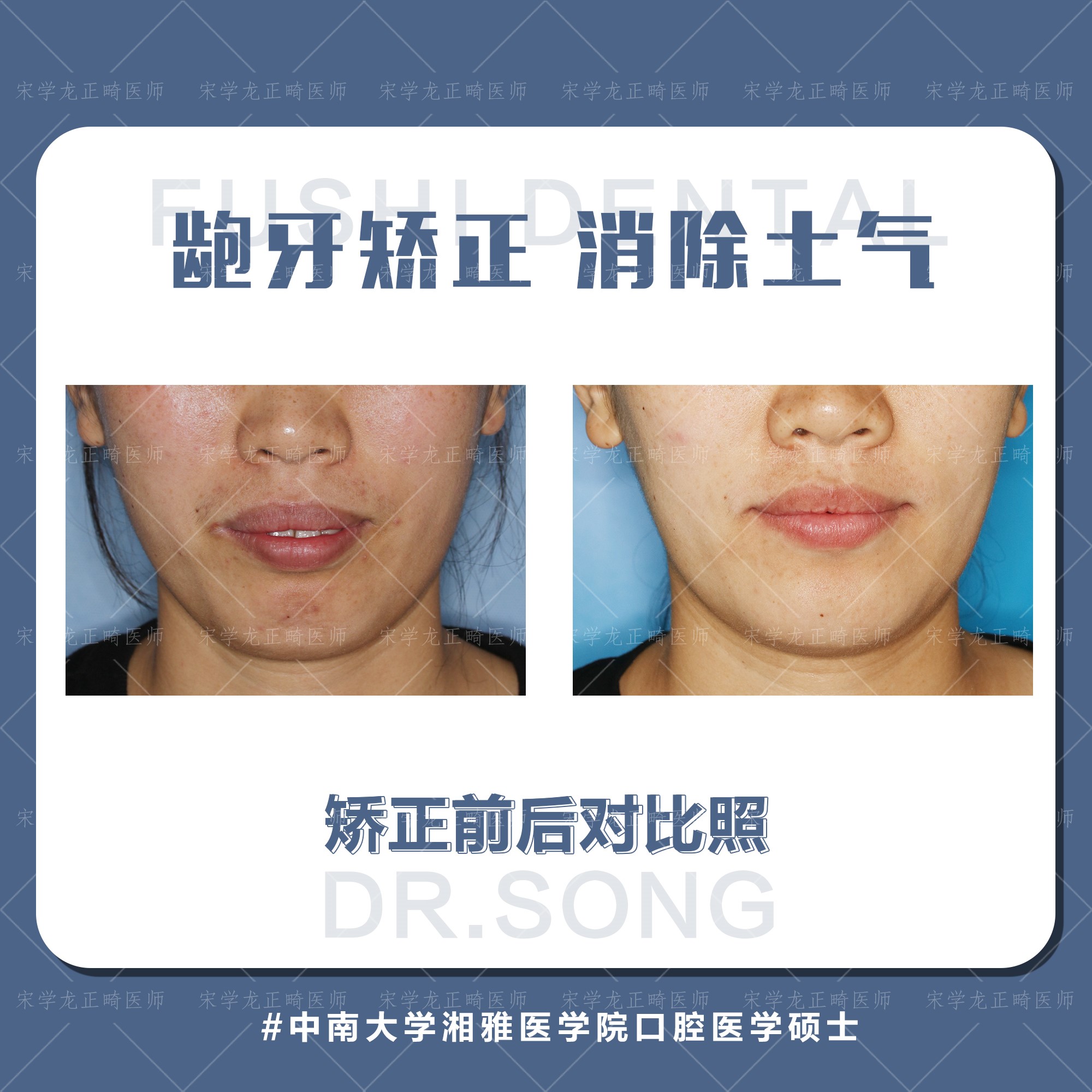 女士凸面型龅牙矫正—义乌傅氏口腔 女士凸面型龅牙矫正—义乌傅氏口腔