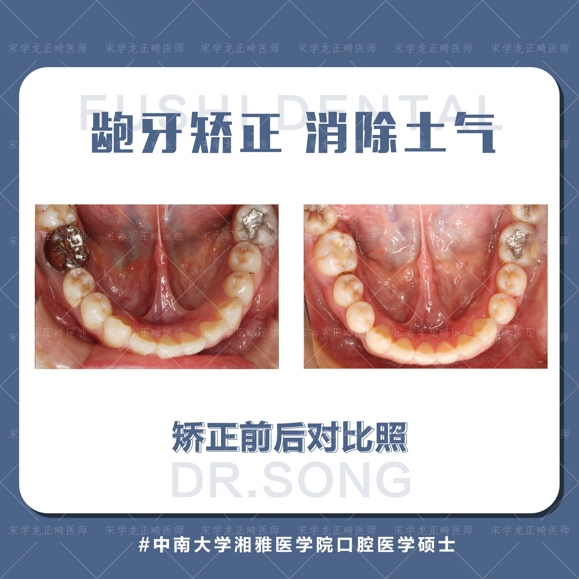 女士凸面型龅牙矫正—义乌傅氏口腔 女士凸面型龅牙矫正—义乌傅氏口腔