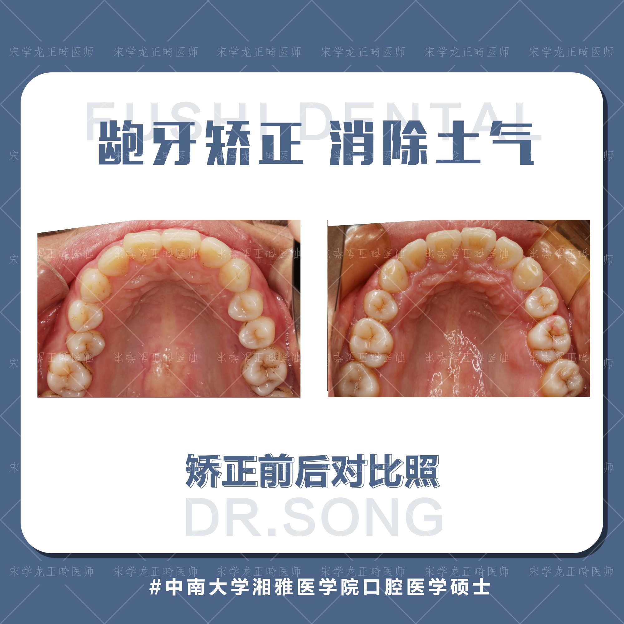 女士凸面型龅牙矫正—义乌傅氏口腔 女士凸面型龅牙矫正—义乌傅氏口腔