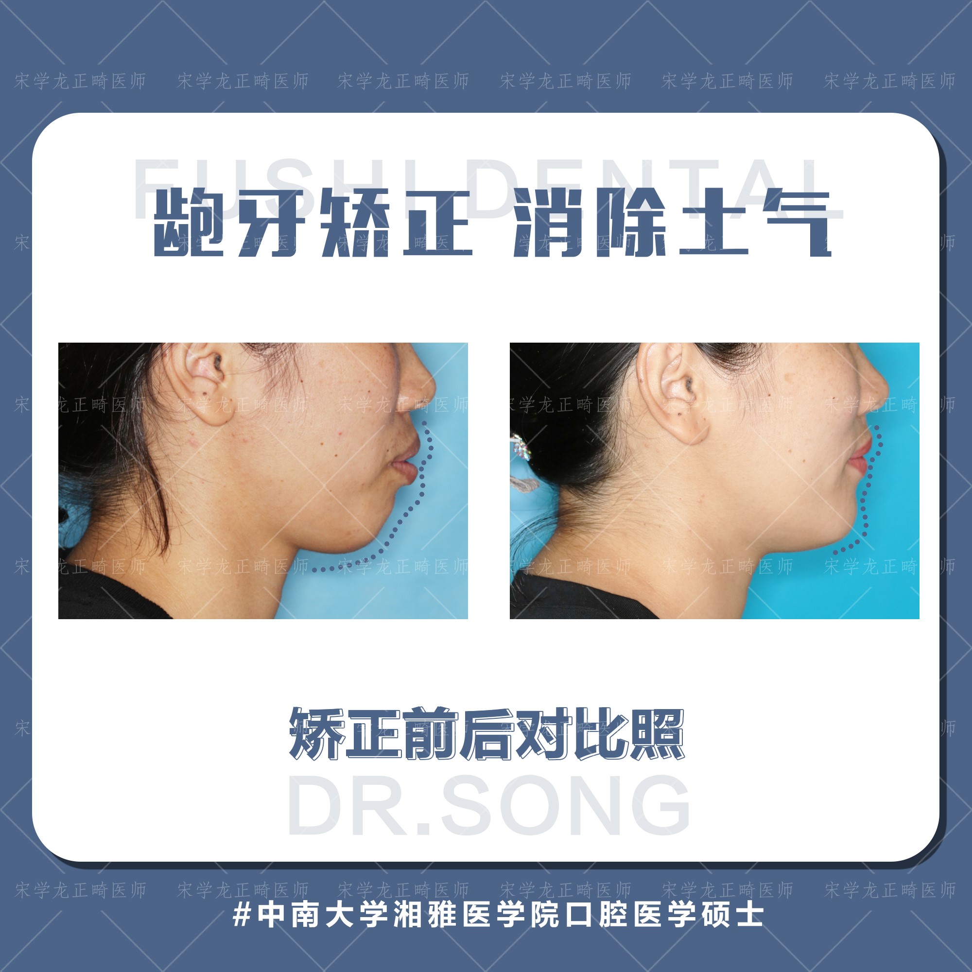 女士凸面型龅牙矫正—义乌傅氏口腔 女士凸面型龅牙矫正—义乌傅氏口腔