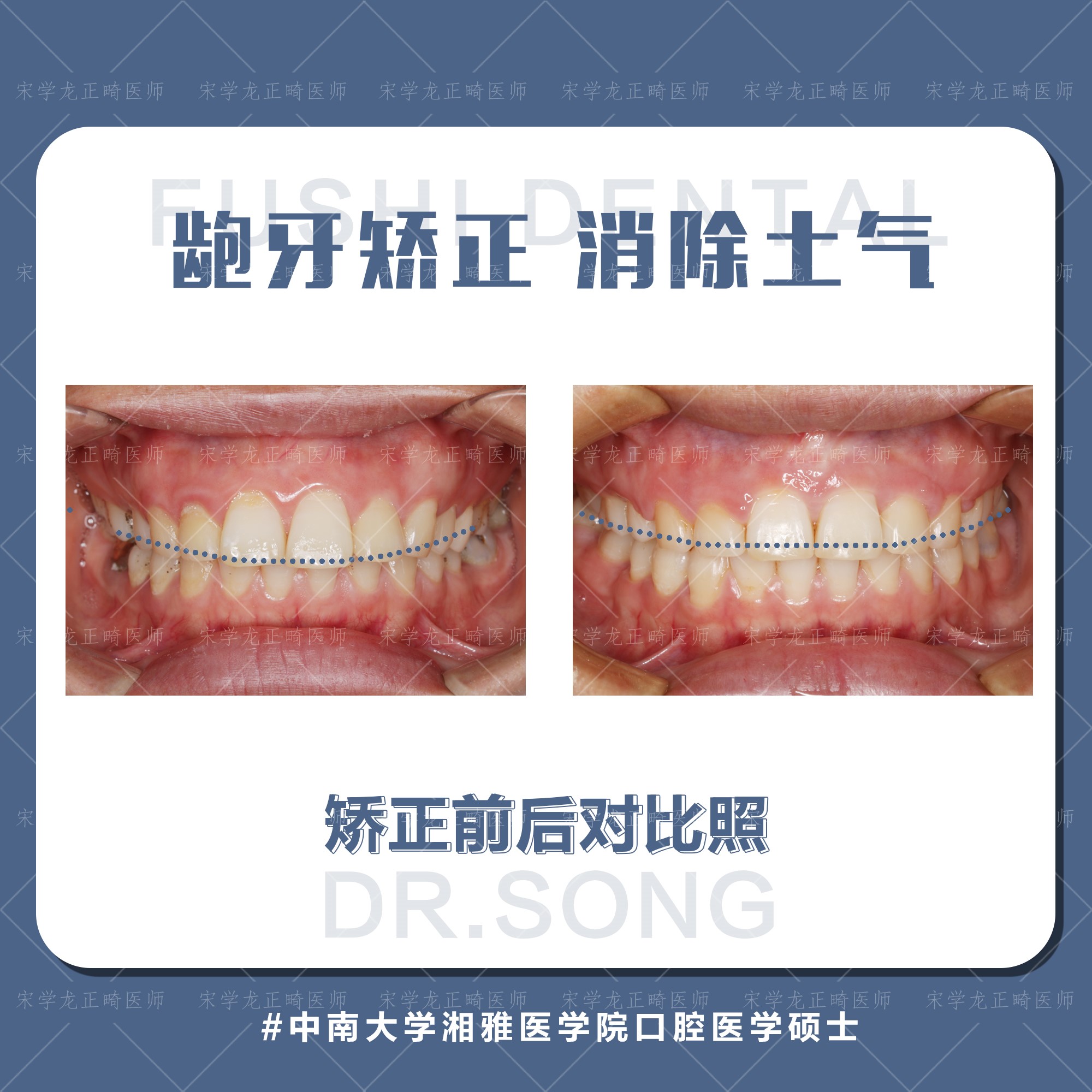 女士凸面型龅牙矫正—义乌傅氏口腔 女士凸面型龅牙矫正—义乌傅氏口腔