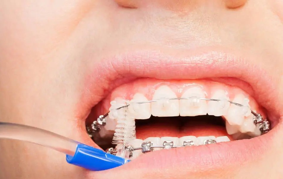 牙齿拥挤不一定就要拔牙矫正？—义乌傅氏口腔