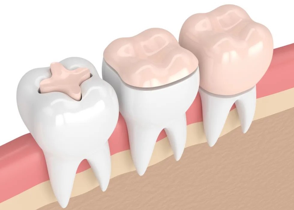 为何补牙前不疼，补完牙反而一直痛？—义乌傅氏口腔