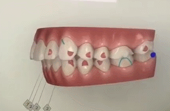 牙齿拥挤不一定就要拔牙矫正？—义乌傅氏口腔