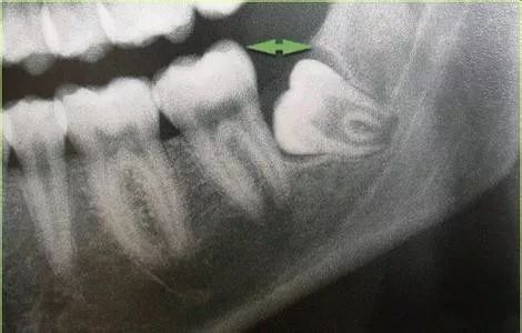 你需要了解的拔牙认识误区！—义乌傅氏口腔