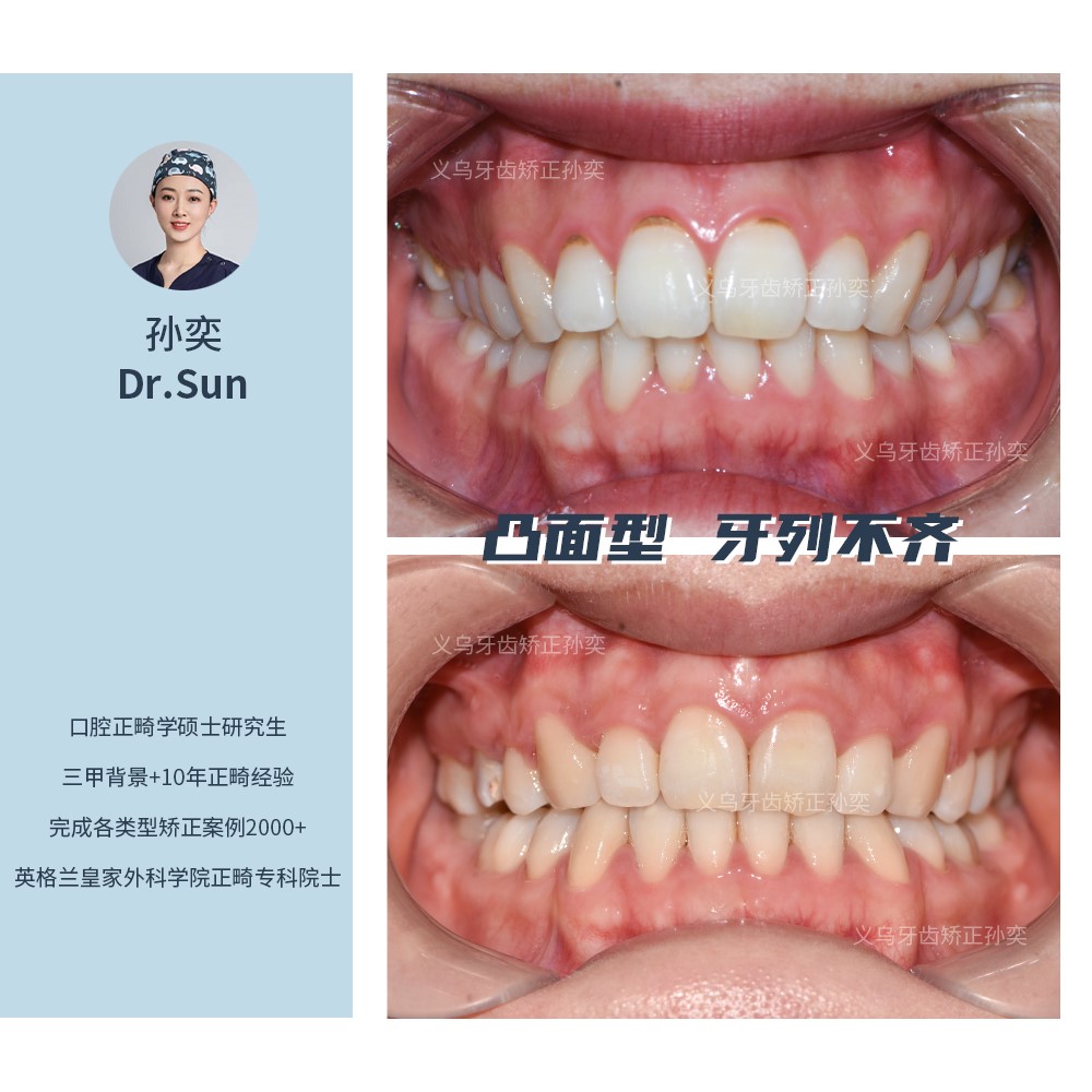 牙齿不齐矫正哪种情况不用拔牙？—义乌牙齿矫正