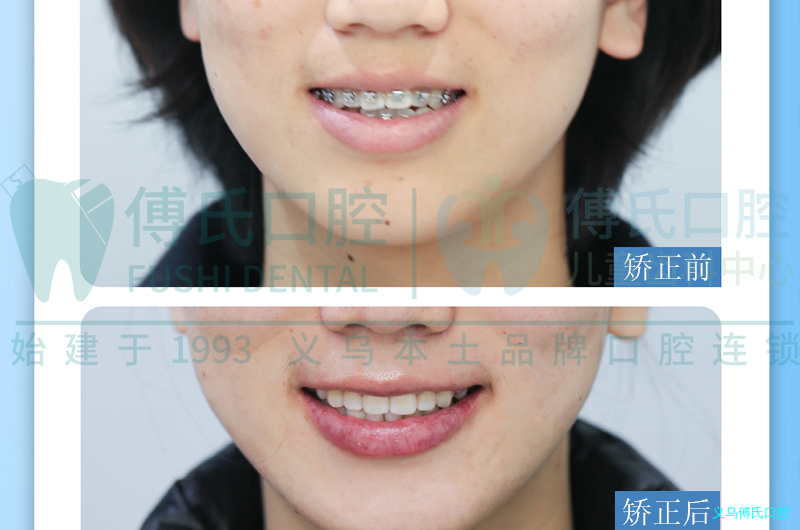 义乌傅氏口腔牙齿矫正 义乌傅氏口腔牙齿矫正