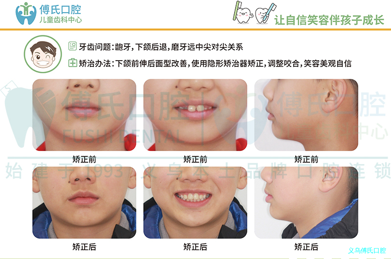 义乌傅氏口腔早期矫正 义乌傅氏口腔早期矫正