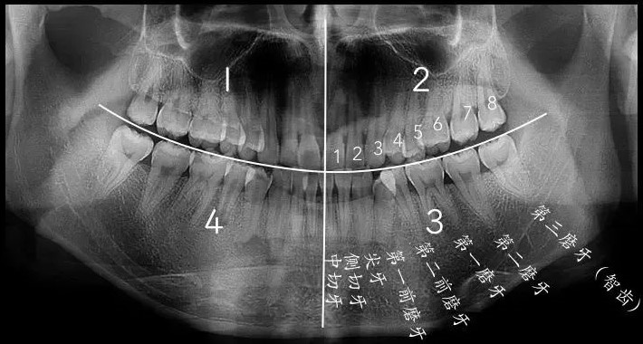 智齿该拔就得拔！