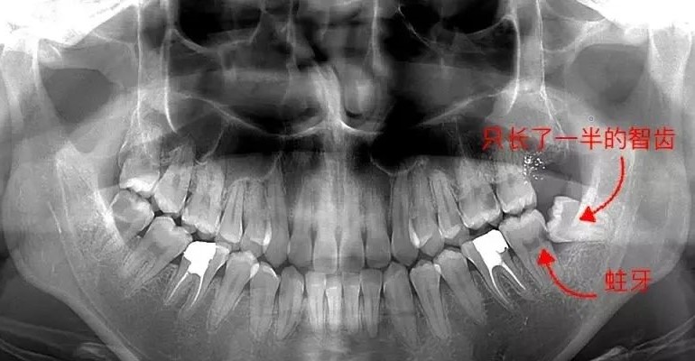 智齿该拔就得拔！
