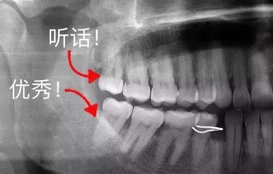 智齿该拔就得拔！