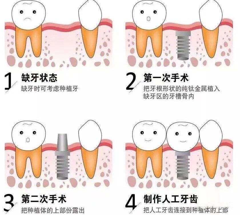 种植牙有哪些优点及缺点? 种植牙有哪些优点及缺点?