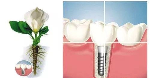 种植牙有哪些优点及缺点? 种植牙有哪些优点及缺点?