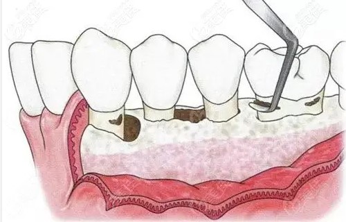 牙周病的典型症状和治疗方法！