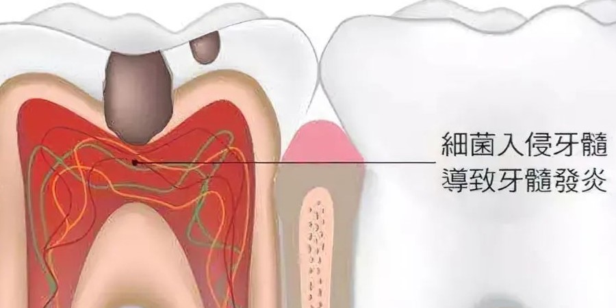 牙疼含口冰水就能好吗？—义乌傅氏口腔