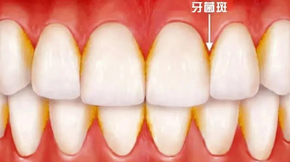 牙龈炎与牙周炎只一字之差，区别竟这么大！