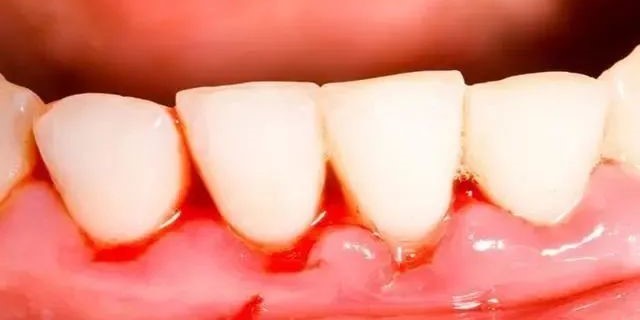 牙龈炎与牙周炎只一字之差，区别竟这么大！