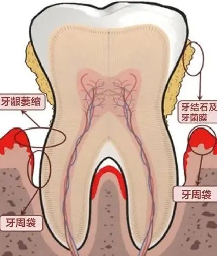 牙龈炎与牙周炎只一字之差，区别竟这么大！