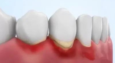 牙龈炎与牙周炎只一字之差，区别竟这么大！