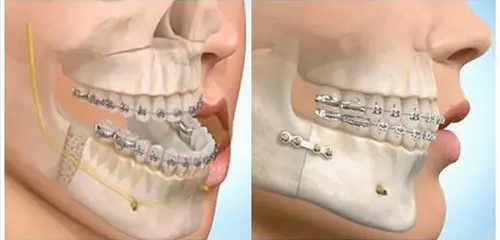 龅牙是遗传的吗？—义乌口腔医院