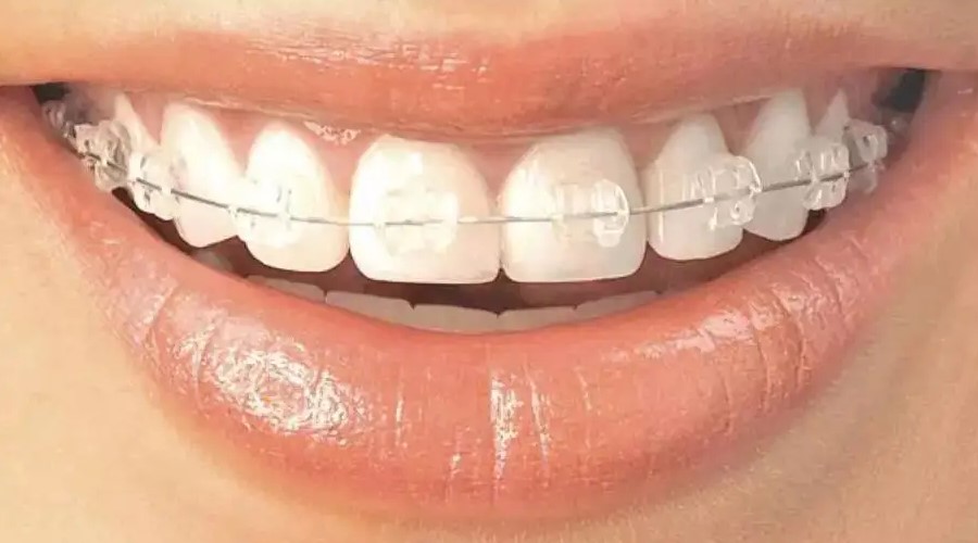 龅牙是遗传的吗？—义乌口腔医院