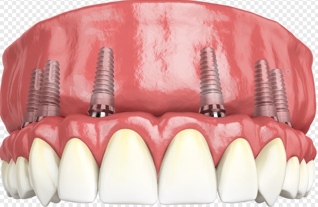 牙齿缺失不补会怎样？