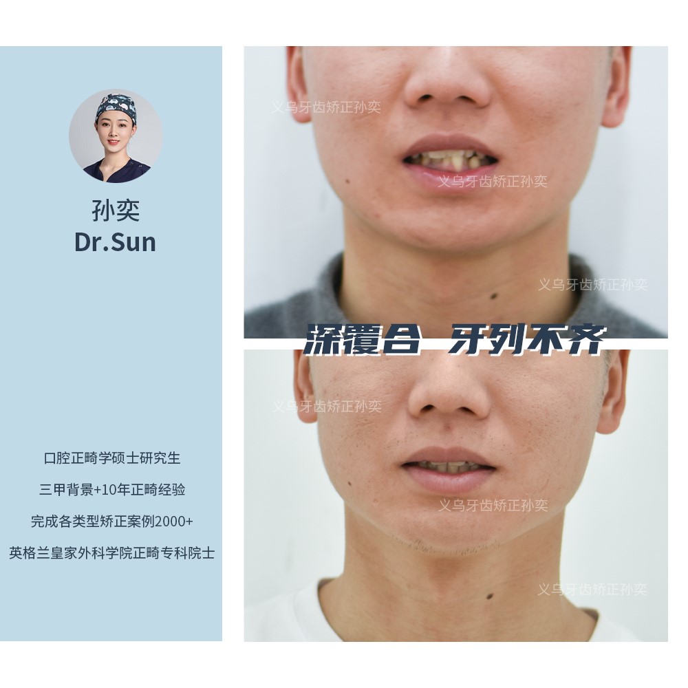 傅氏口腔深覆合牙列不齐不拔牙矫正案例分享！