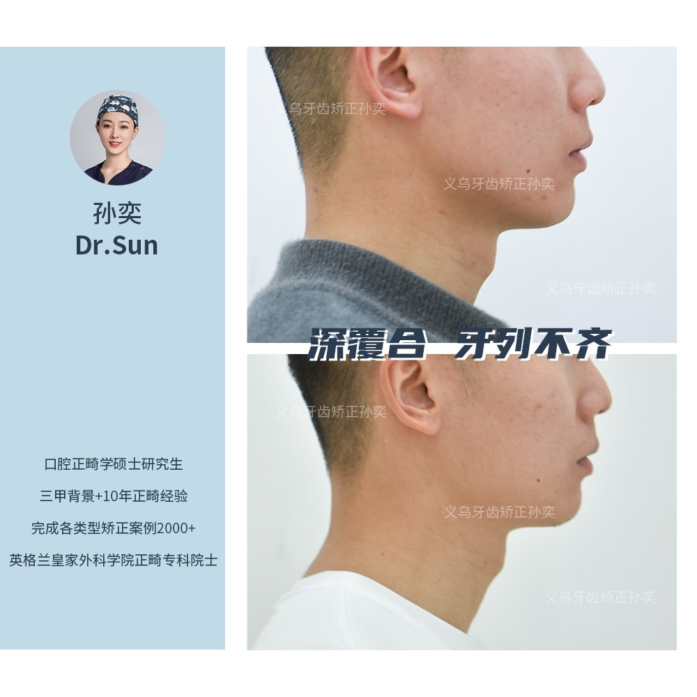 傅氏口腔深覆合牙列不齐不拔牙矫正案例分享！