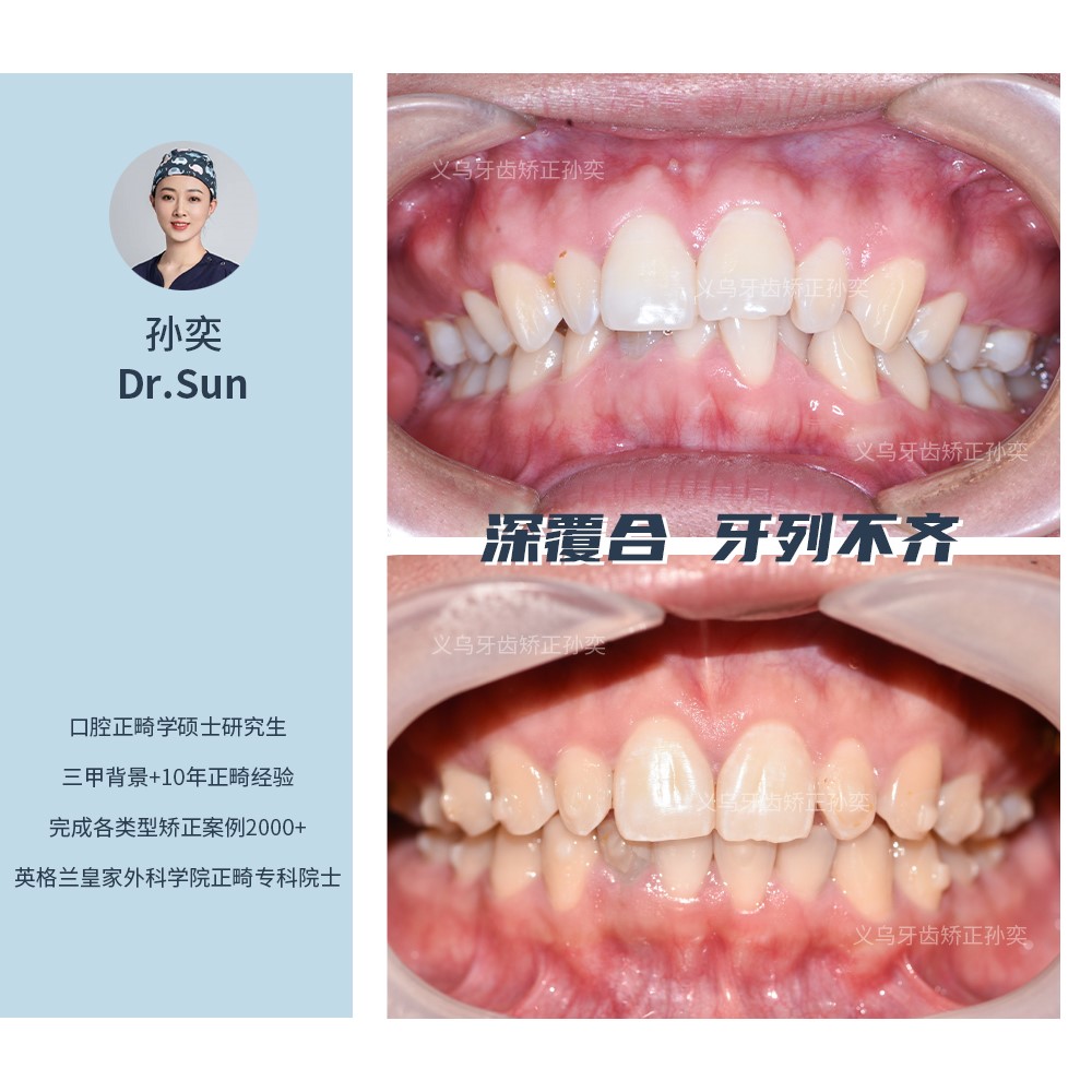 傅氏口腔深覆合牙列不齐不拔牙矫正案例分享！