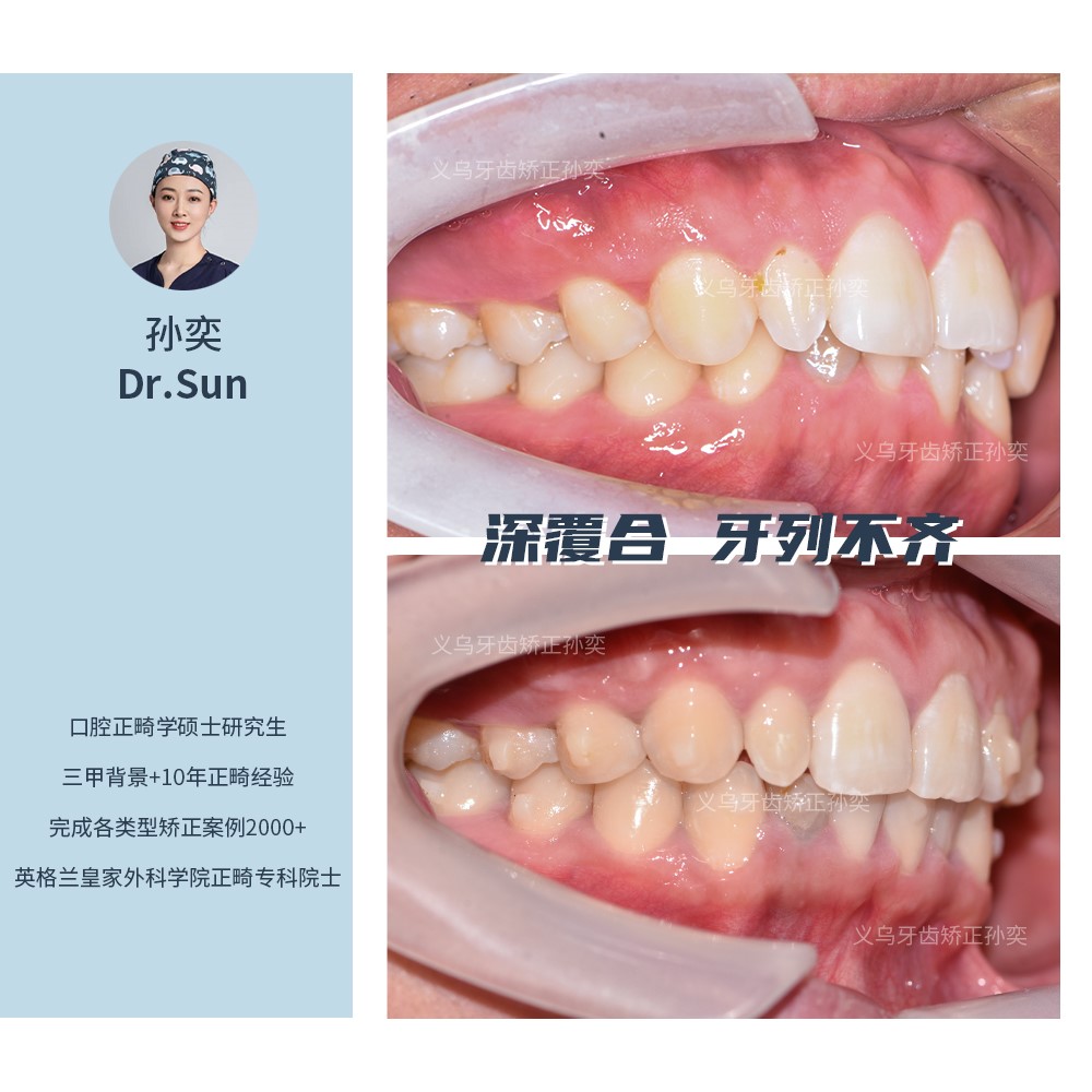 傅氏口腔深覆合牙列不齐不拔牙矫正案例分享！