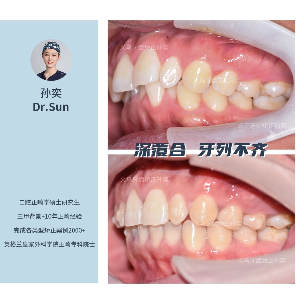 傅氏口腔深覆合牙列不齐不拔牙矫正案例分享！