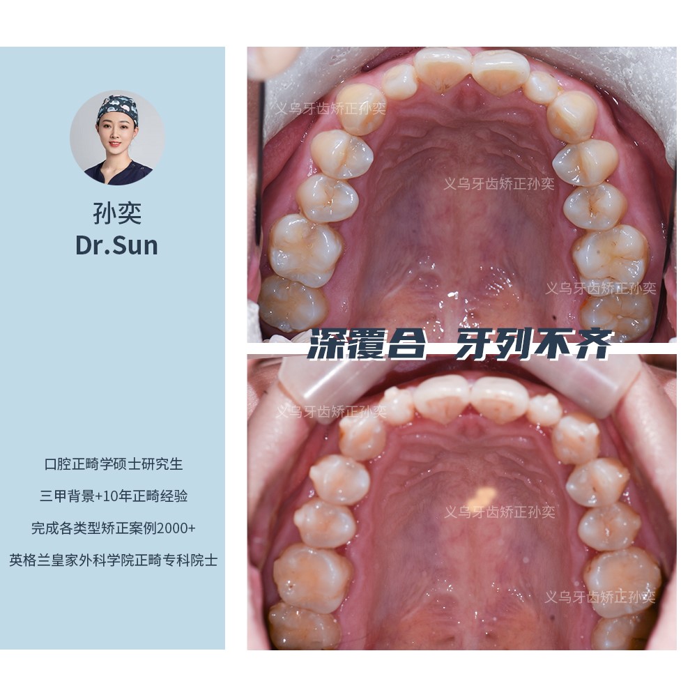 傅氏口腔深覆合牙列不齐不拔牙矫正案例分享！