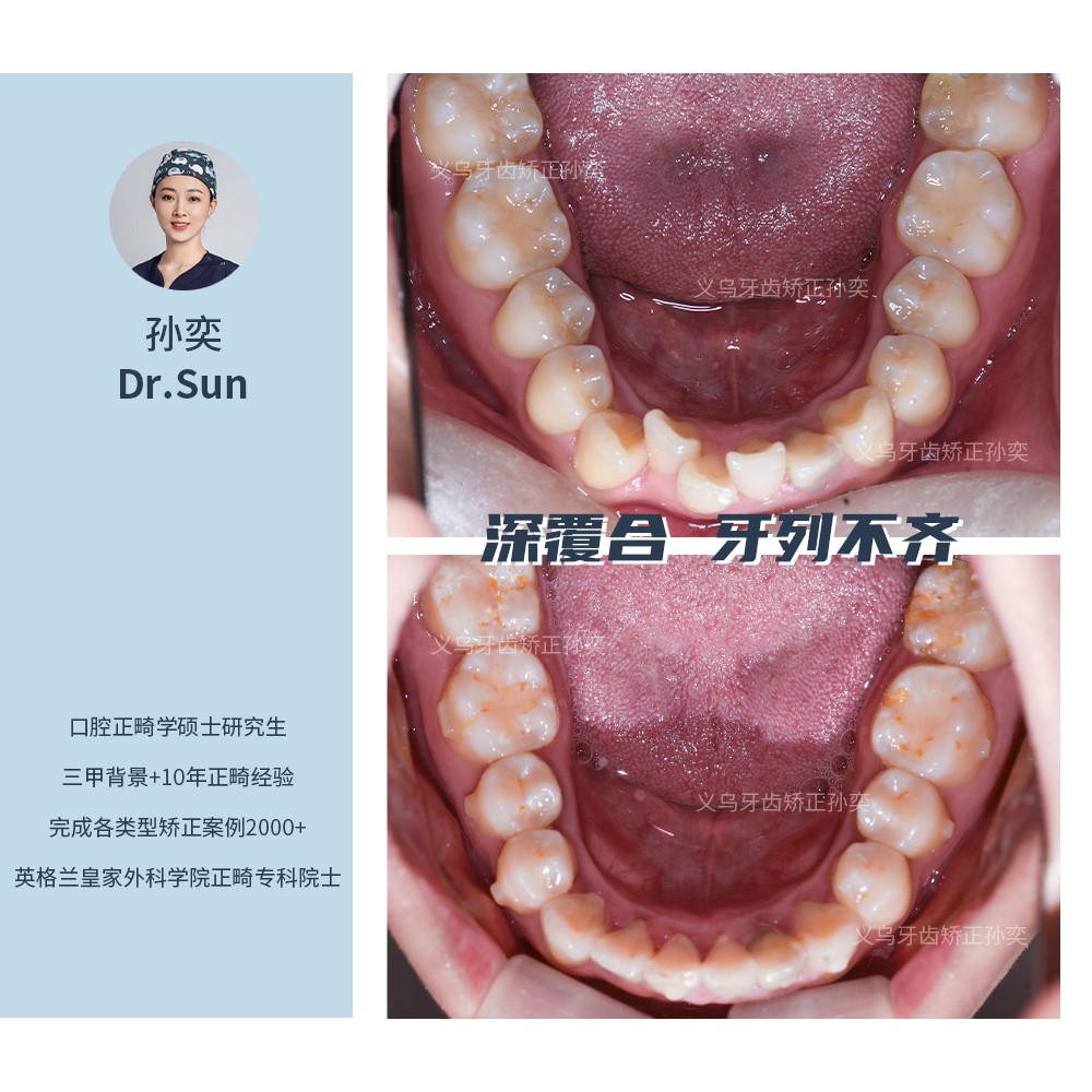 傅氏口腔深覆合牙列不齐不拔牙矫正案例分享！
