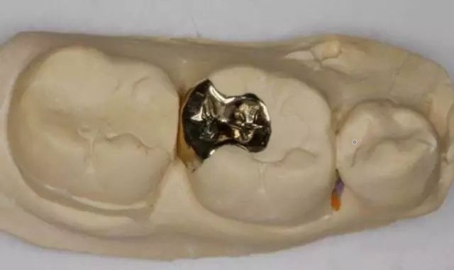 为何补牙的材料容易脱落?—义乌傅氏口腔 为何补牙的材料容易脱落?—义乌傅氏口腔