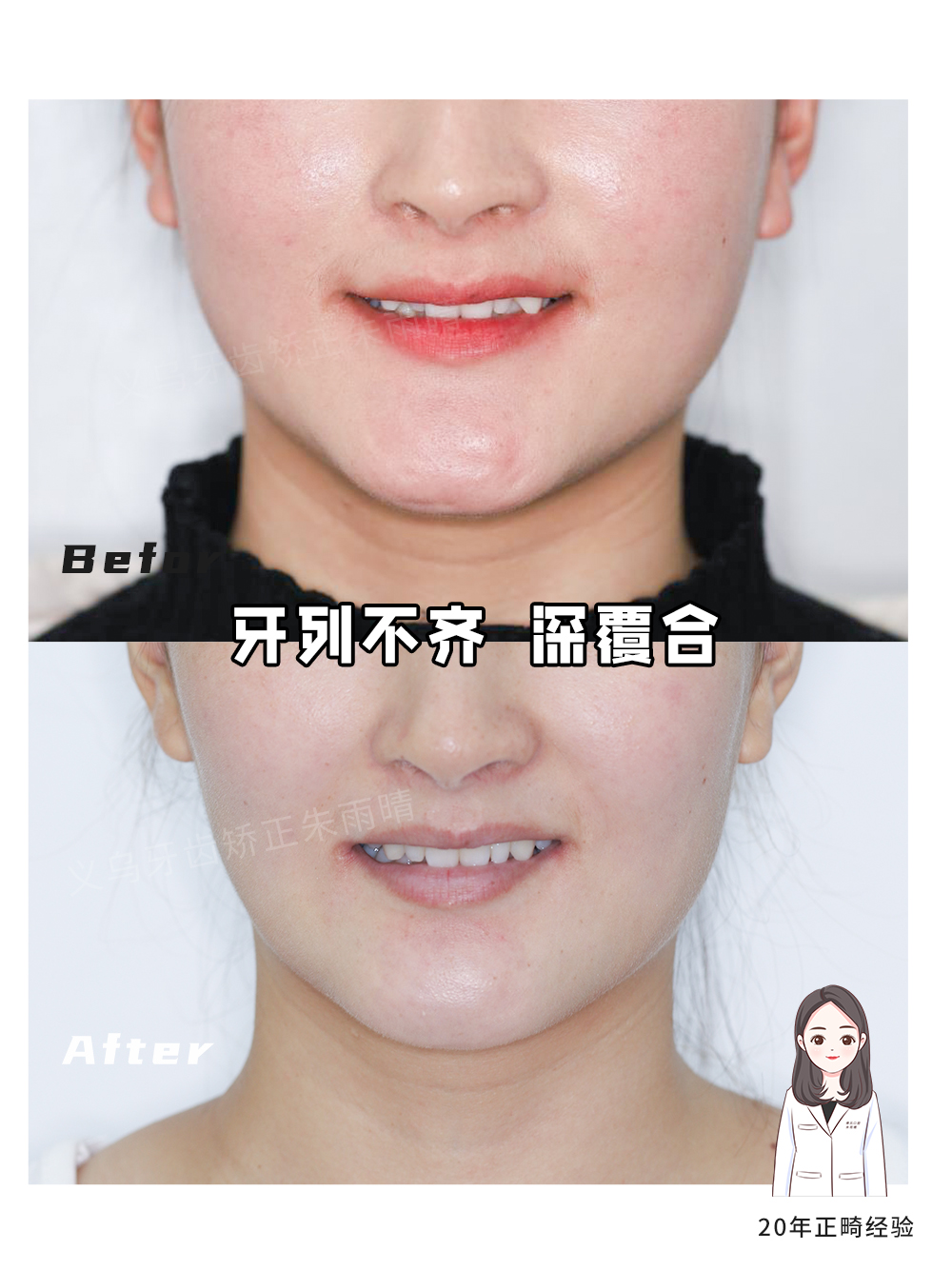 义乌傅氏口腔牙列不齐、深覆合矫正案例分享！