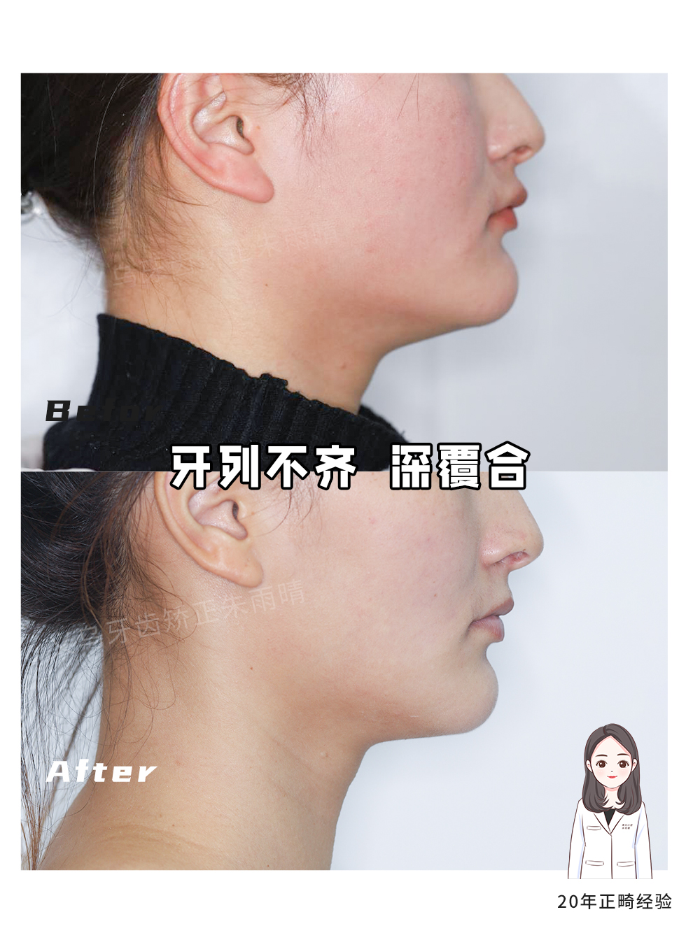 义乌傅氏口腔牙列不齐、深覆合矫正案例分享！