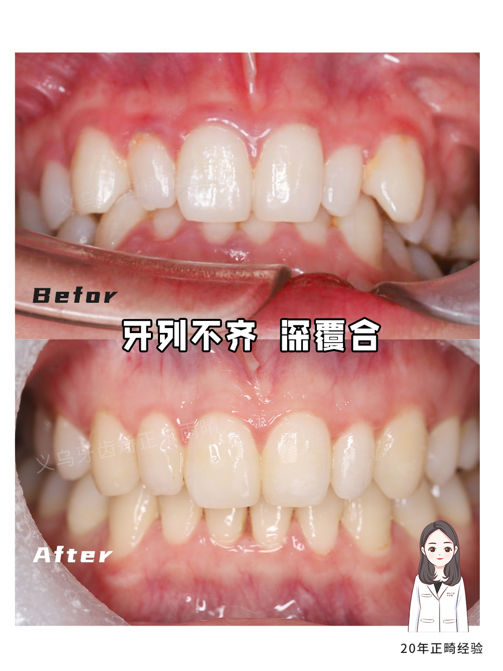 义乌傅氏口腔牙列不齐、深覆合矫正案例分享！