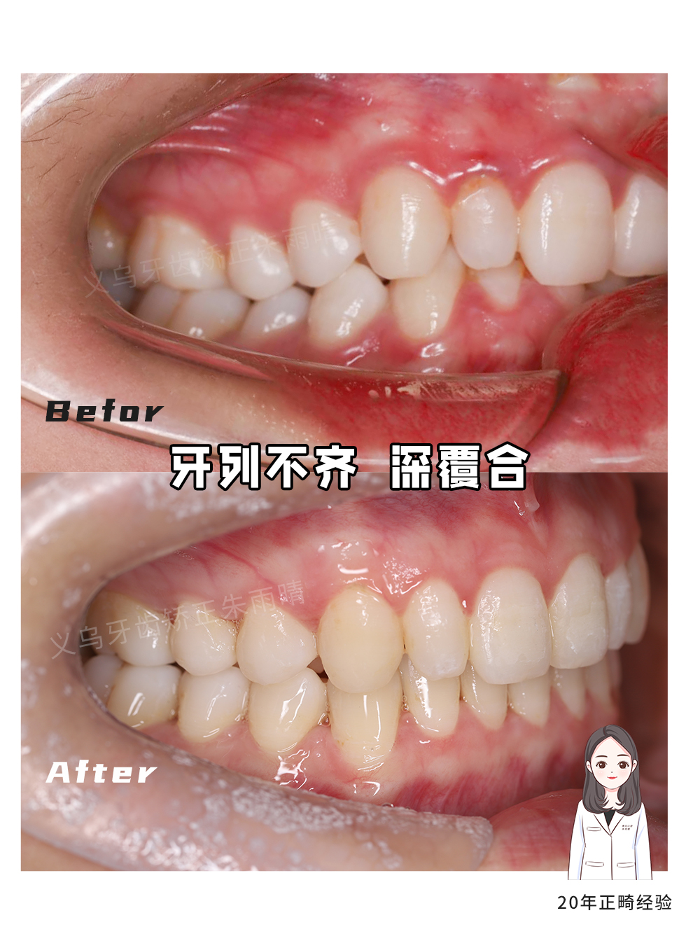 义乌傅氏口腔牙列不齐、深覆合矫正案例分享！