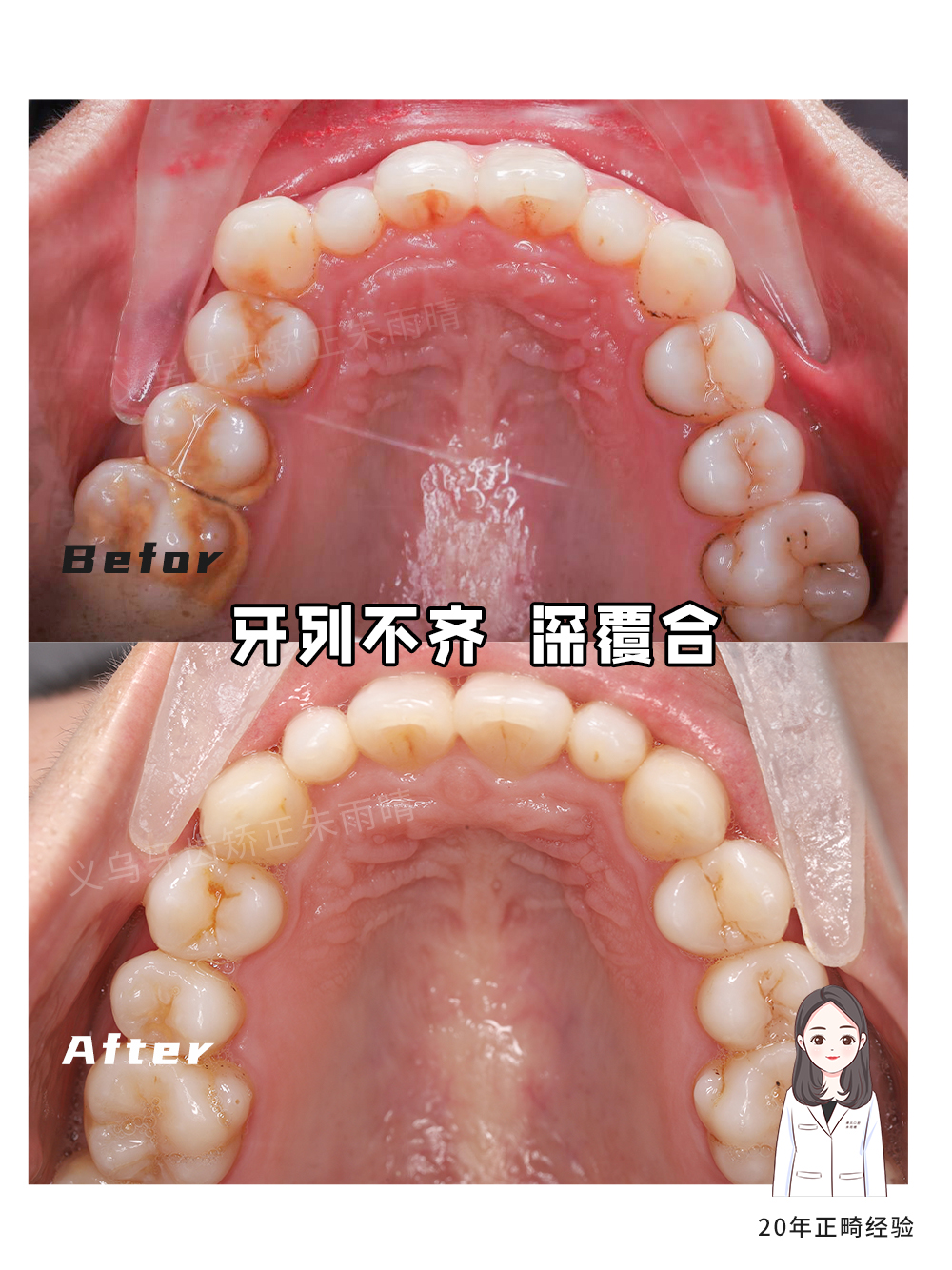 义乌傅氏口腔牙列不齐、深覆合矫正案例分享！