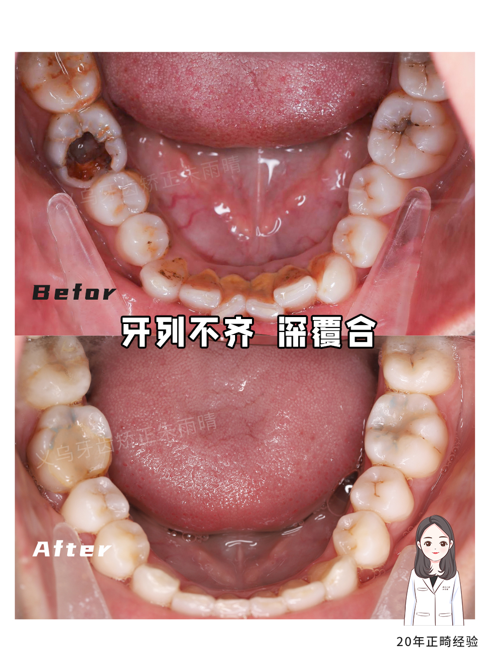 义乌傅氏口腔牙列不齐、深覆合矫正案例分享！