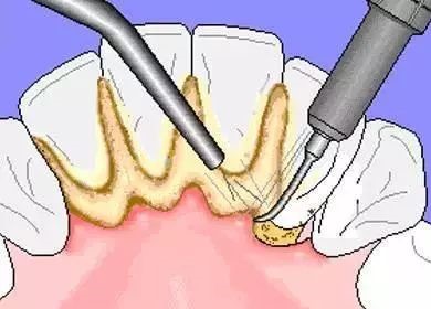 为什么都是洗牙,价格却不一样? 为什么都是洗牙,价格却不一样?