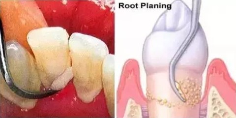 为什么都是洗牙,价格却不一样? 为什么都是洗牙,价格却不一样?