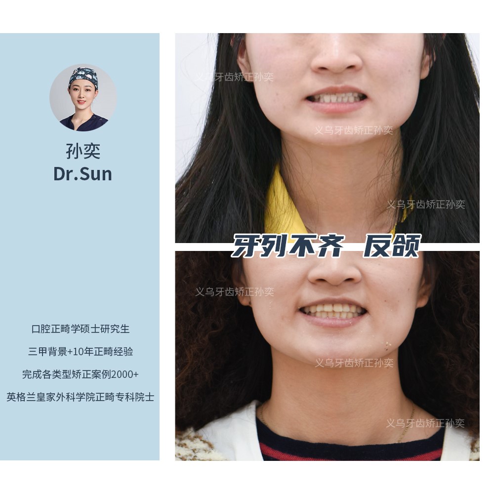 义乌傅氏口腔牙列不齐，反颌矫正案例分享！