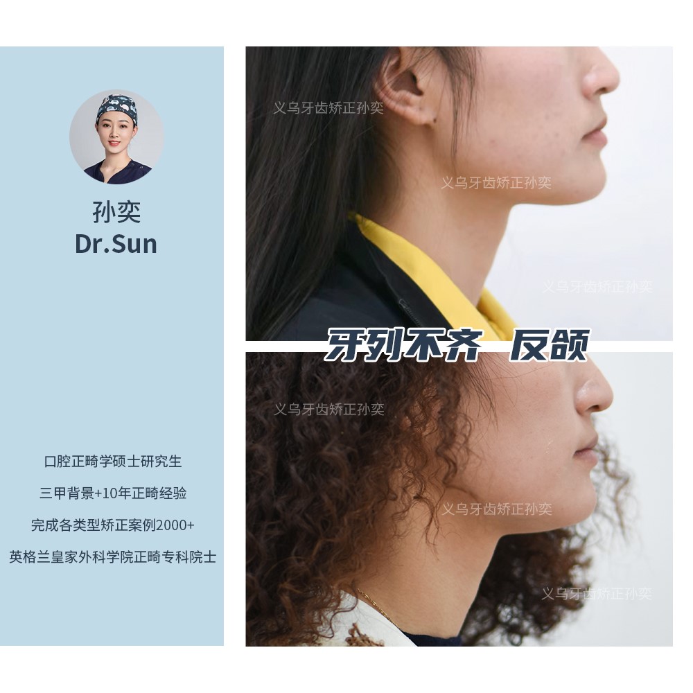 义乌傅氏口腔牙列不齐，反颌矫正案例分享！