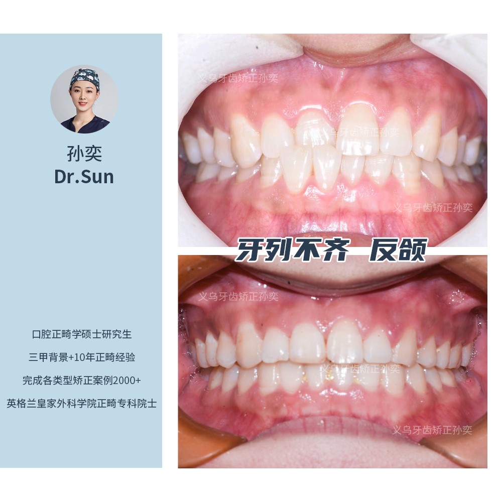 义乌傅氏口腔牙列不齐，反颌矫正案例分享！