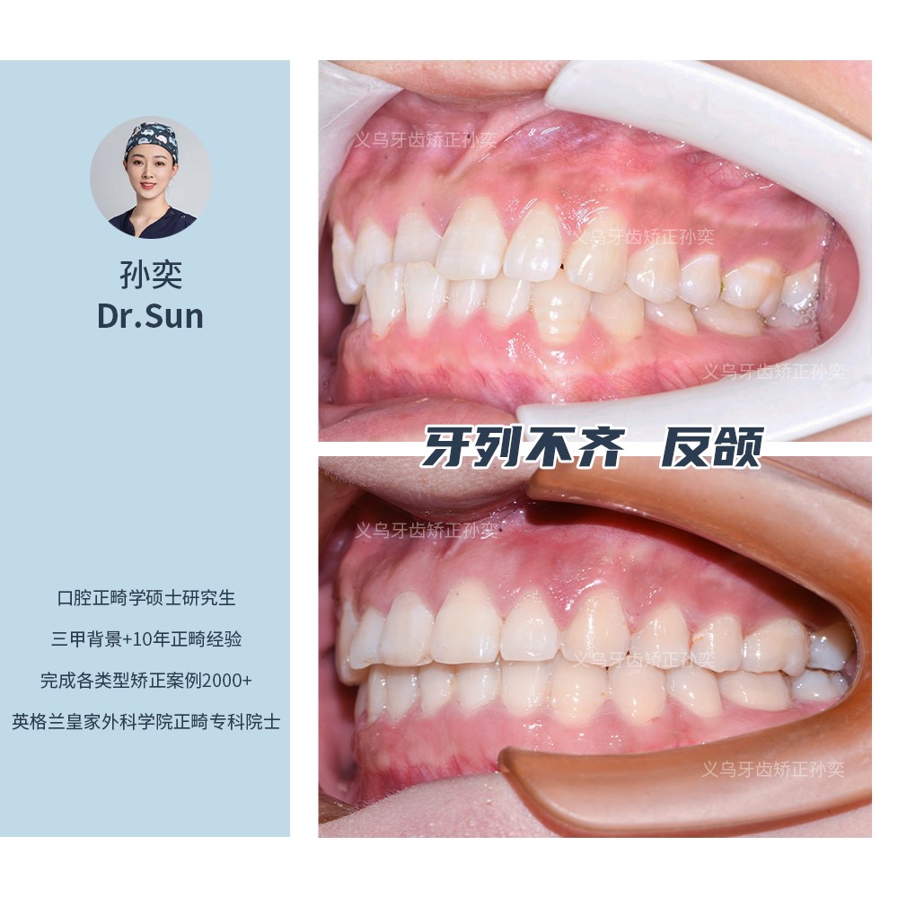 义乌傅氏口腔牙列不齐，反颌矫正案例分享！